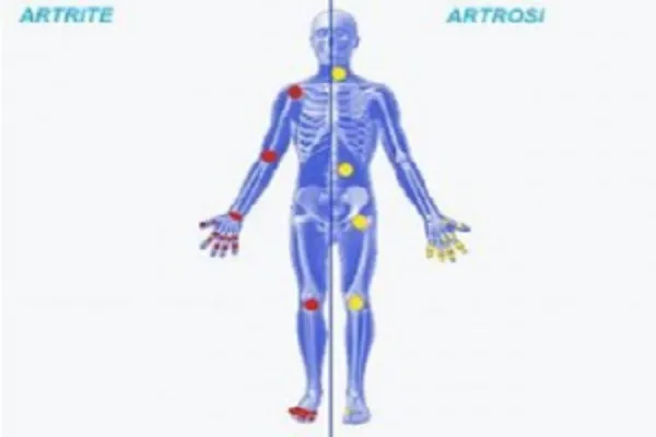 Artrite o artrosi, come riconoscerle? Differenze e cura adeguata