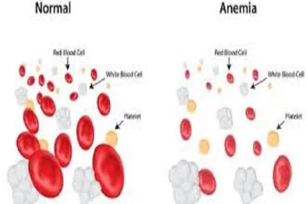 Svolta cura anemia mediterranea: chirurgia chimica su DNA elimina talassemia