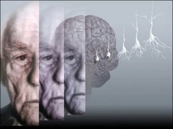 Alzheimer, ansia primo indicatore della malattia