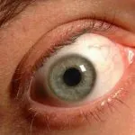 Glaucoma, malattia fulminante della vista: si può prevenire?