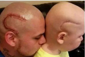 Bimbo di 9 anni muore di cancro: il padre si era tatuato la sua stessa cicatrice