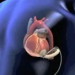 Niguarda, primo trapianto di cuore artificiale effettuato in Italia con telemonitoraggio