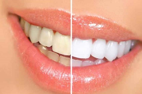 Denti bianchi rovinati da diete e drink, perché?