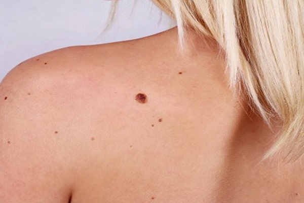 Neo che cambia forma, i rischi di melanoma sulla pelle