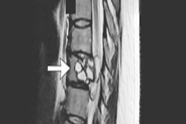 Scoperta shock, formicolio alle gambe scopre una tenia di cane nella schiena