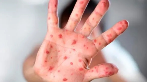 Morbillo: record di casi in Europa, Italia uno dei paesi peggiori