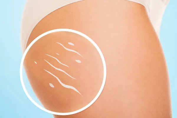 Come eliminare la cellulite, i rimedi più efficaci